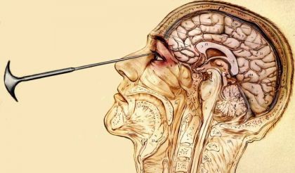 Lobotomia – cea mai controversată intervenție neurologică din istorie. Azi e interzisă